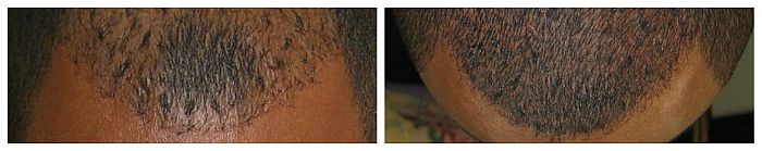 Cosmetic tattooing for men: Permanent Hairline Men